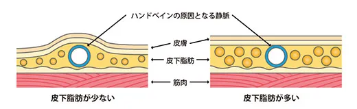 皮下脂肪量の減少